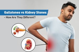 How Do Gallstones Differ from Kidney Stones?