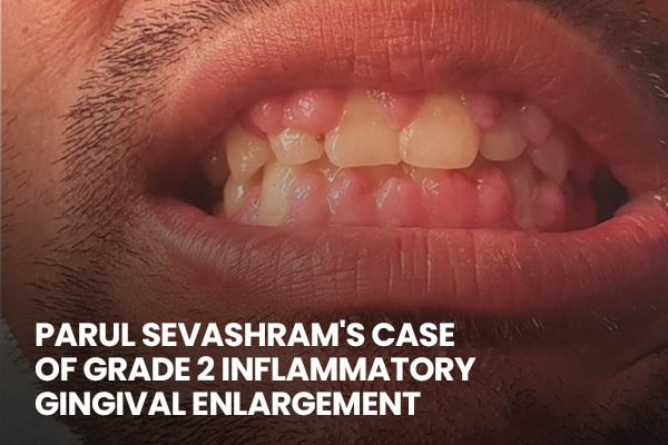 grade-2-inflammatory-gingival-enlargement