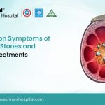 kidney stones treatments