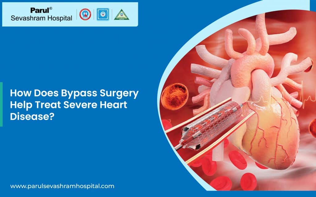 Bypass Surgery in Vadodara