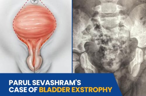 Bladder Exstrophy Case Study