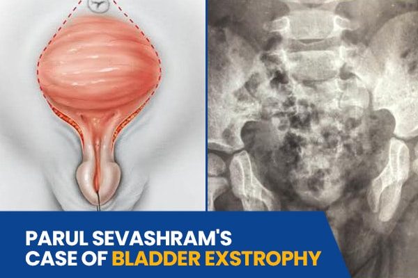 Bladder Exstrophy Case Study